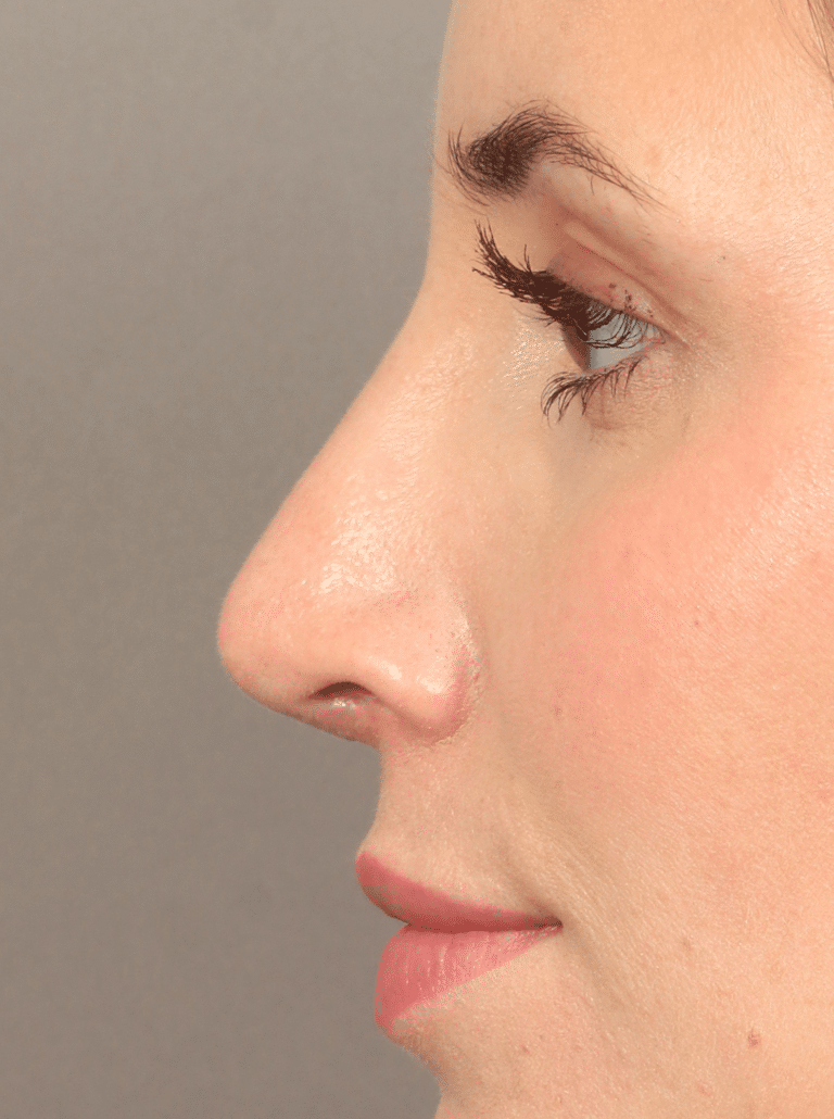 After Image: Rhinoplasty (5.5 Months Post-op) - left-side