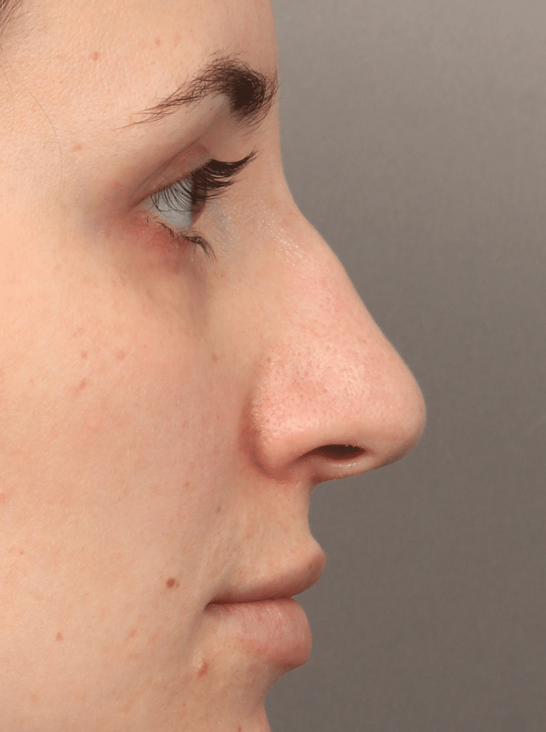 Before Image: Rhinoplasty (5.5 Months Post-op) - right-side