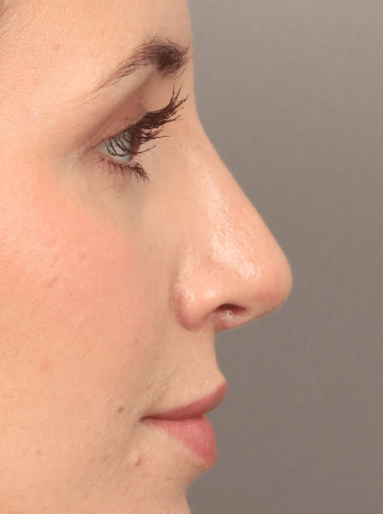 After Image: Rhinoplasty (5.5 Months Post-op) - right-side