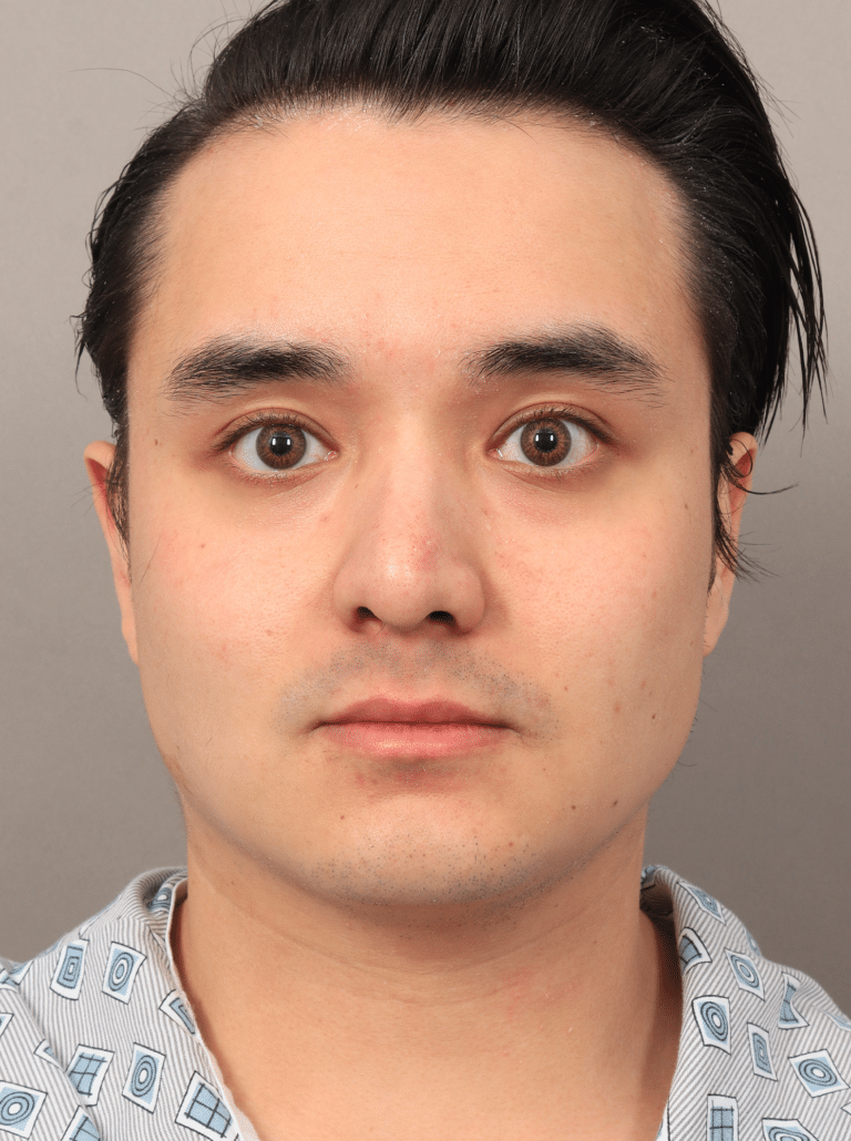 Before Image: Liposuction, Renuvion Skin Tightening, and Fat Grafting - front