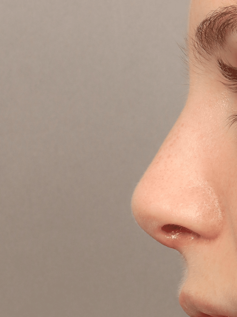 After Image: Rhinoplasty & Septoplasty (1 Month Post-op) - left-side