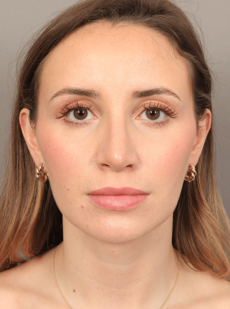After Image: Rhinoplasty (5.5 Months Post-op) -