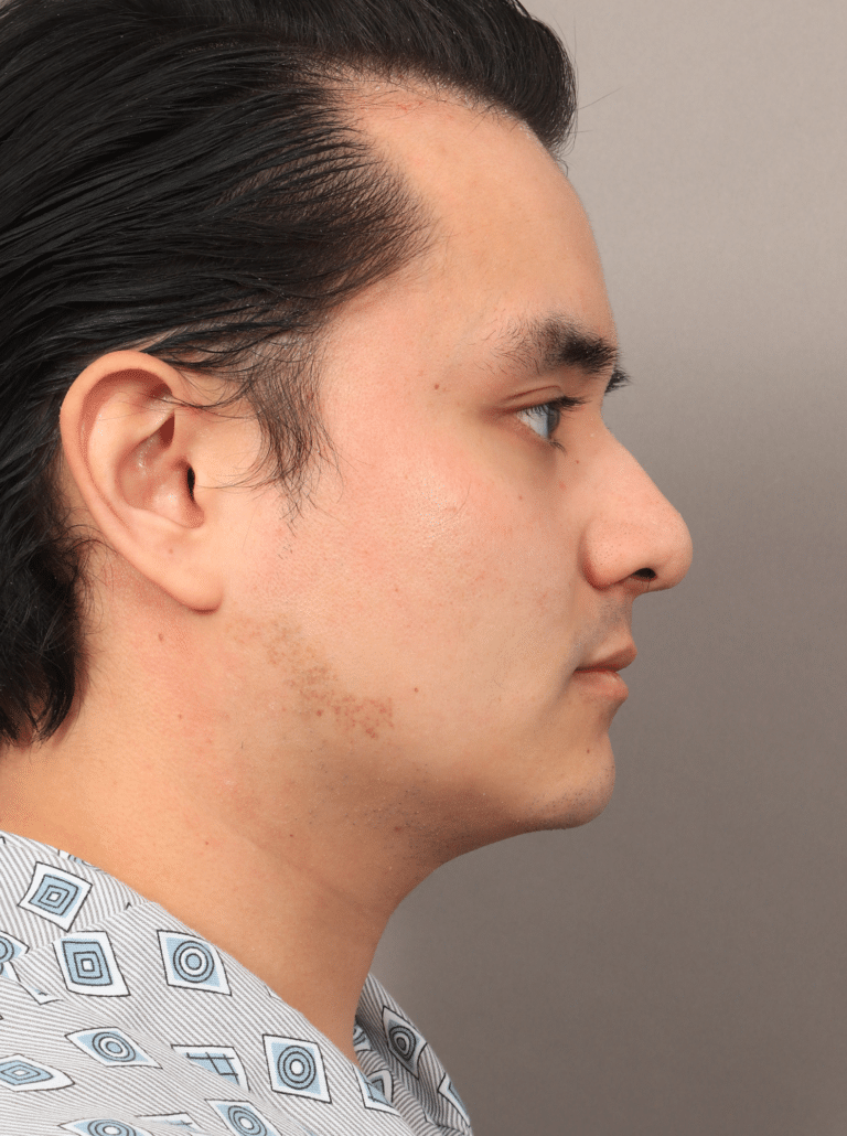Before Image: Liposuction, Renuvion Skin Tightening, and Fat Grafting - right-side