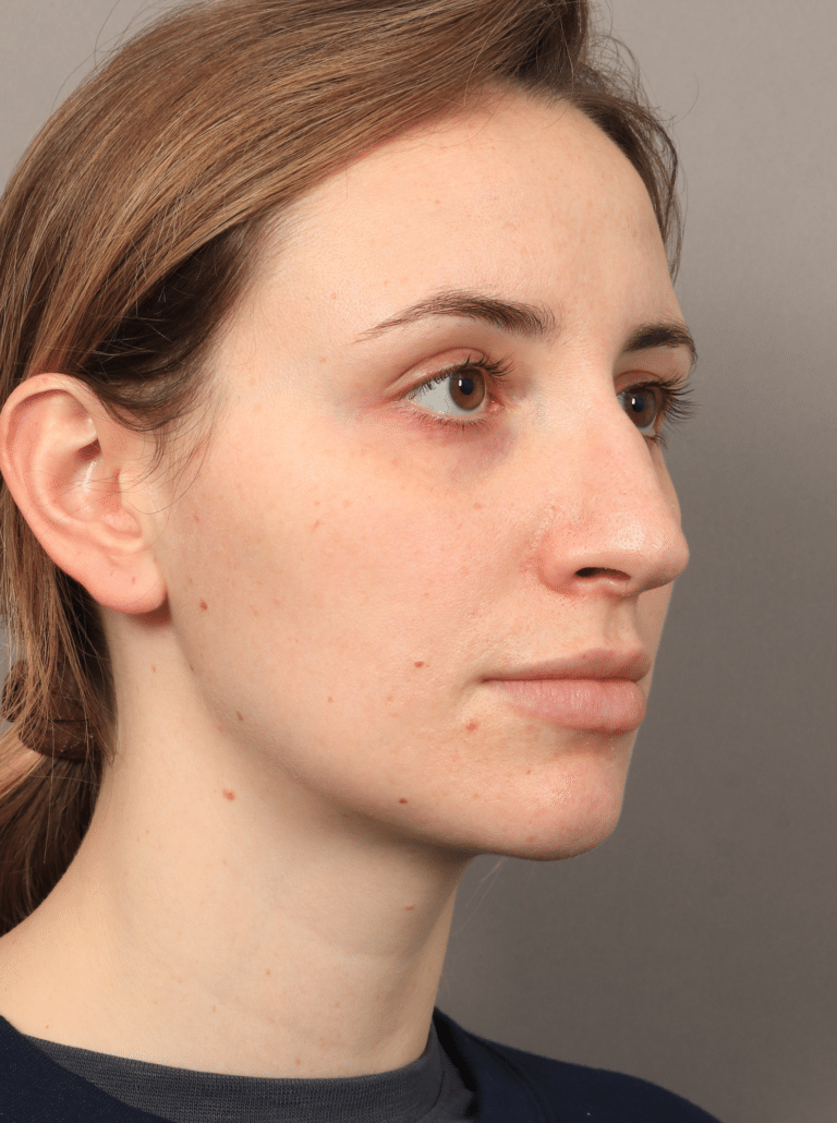 Before Image: Rhinoplasty (5.5 Months Post-op) - right-front-oblique