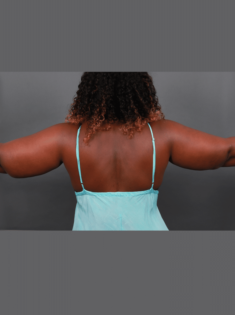 Before Image: Liposuction and Renuvion Skin Tightening (11 Months Post-op) - back