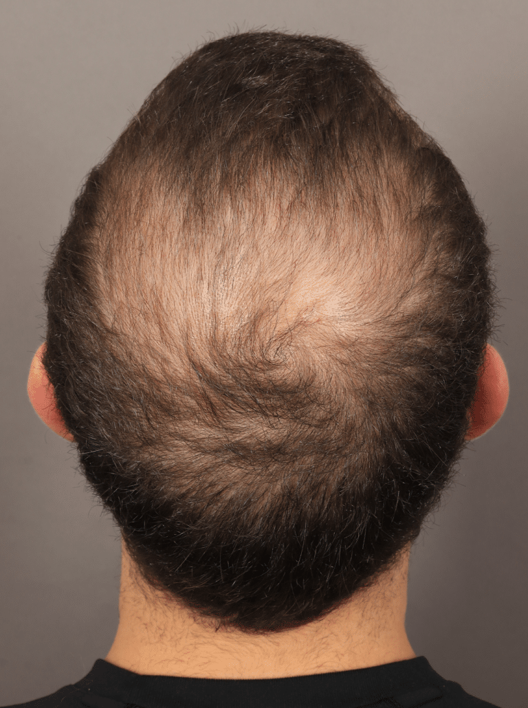 Before Image: NeoGraft Hair Transplant (7 Months Post-op) - back