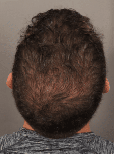 After Image: NeoGraft Hair Transplant (7 Months Post-op)