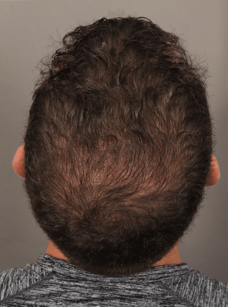After Image: NeoGraft Hair Transplant (7 Months Post-op) - back