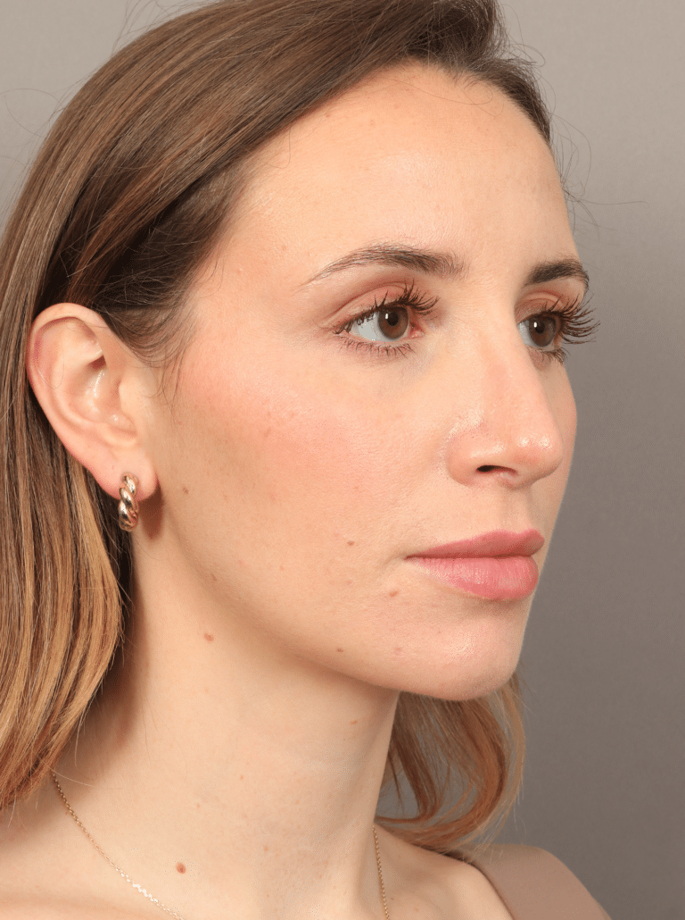After Image: Rhinoplasty (5.5 Months Post-op) - right-front-oblique