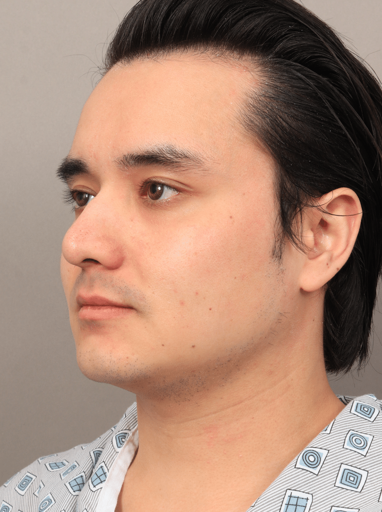 Before Image: Liposuction, Renuvion Skin Tightening, and Fat Grafting - left-front-oblique