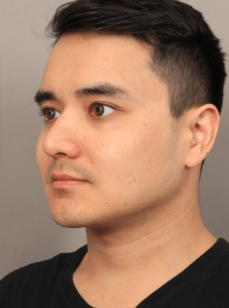 After Image: Liposuction, Renuvion Skin Tightening, and Fat Grafting - left-front-oblique