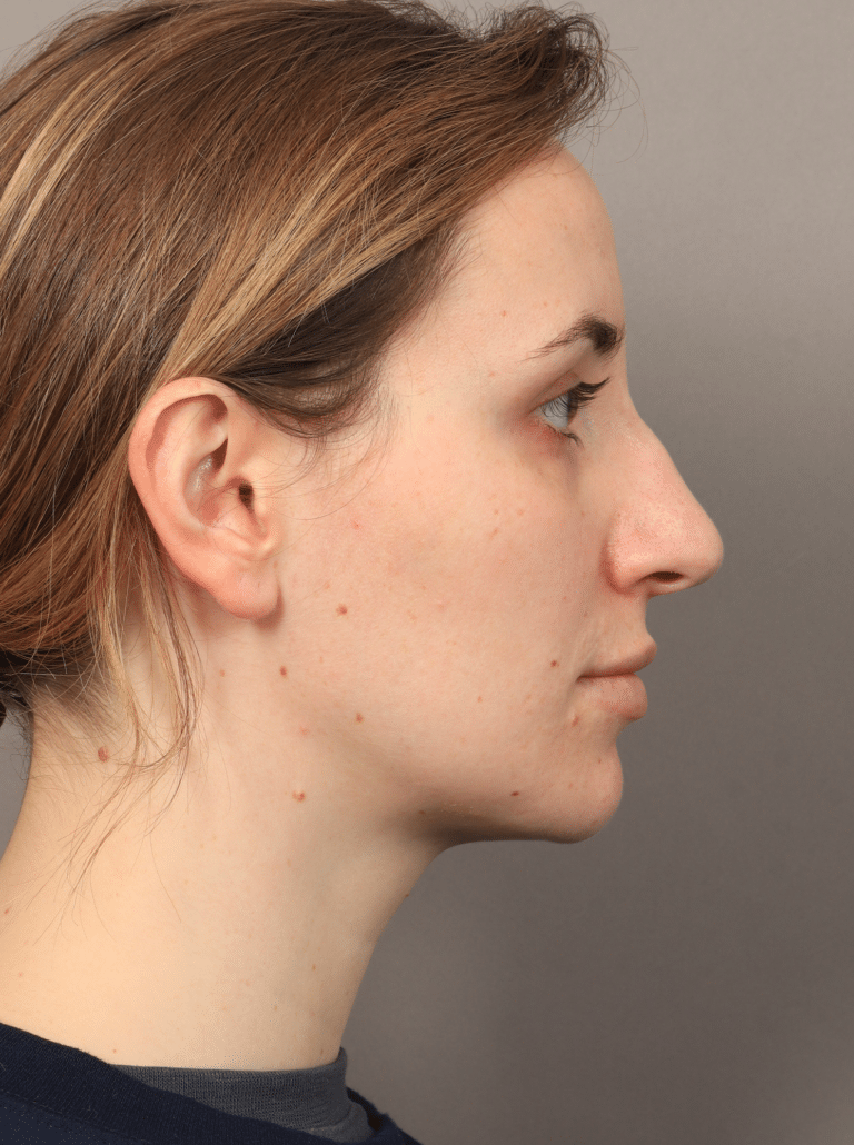 Before Image: Rhinoplasty (5.5 Months Post-op) - right-side