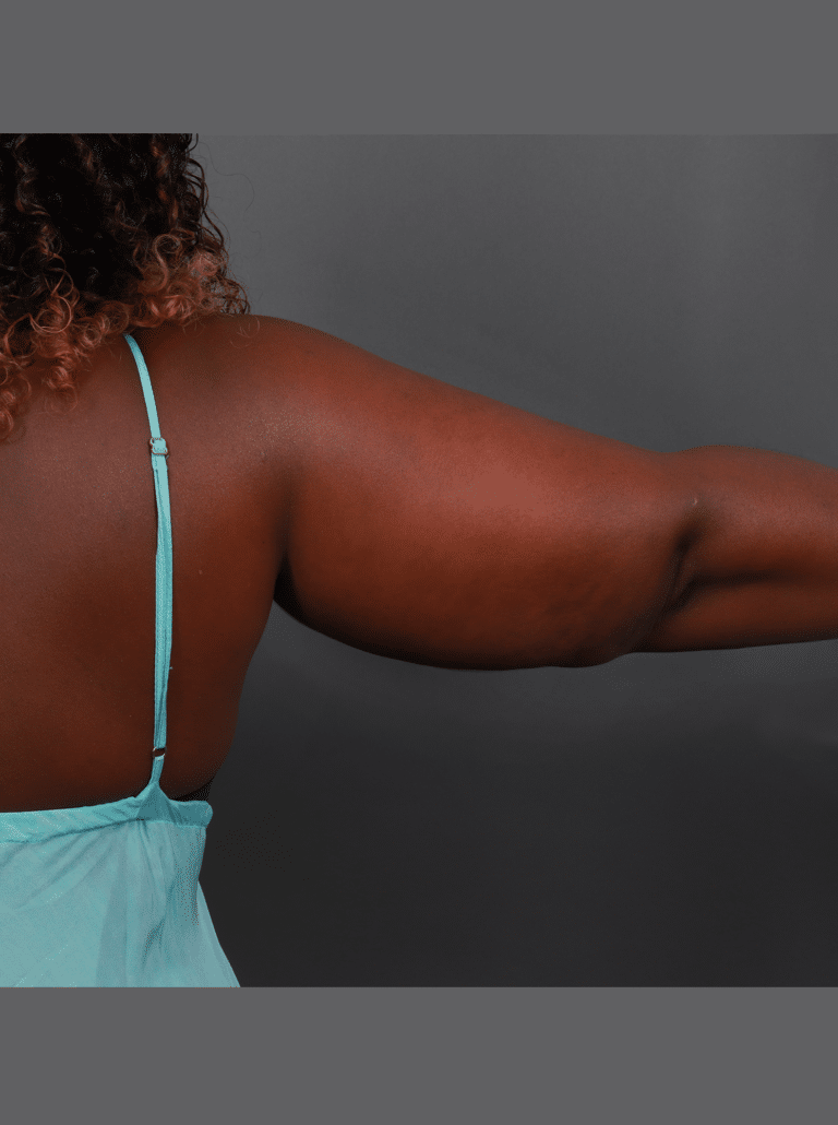 Before Image: Liposuction and Renuvion Skin Tightening (11 Months Post-op) - right-side