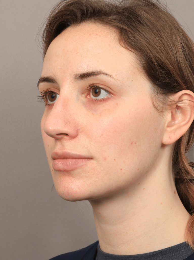 Before Image: Rhinoplasty (5.5 Months Post-op) - left-front-oblique