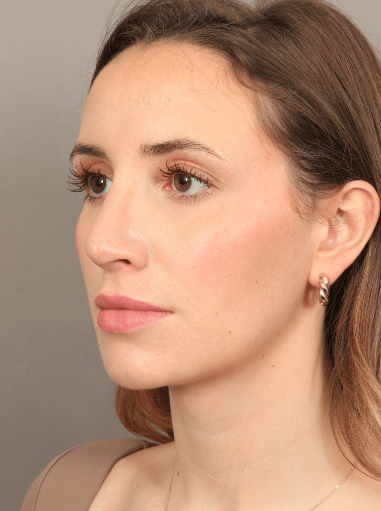 After Image: Rhinoplasty (5.5 Months Post-op) - left-front-oblique