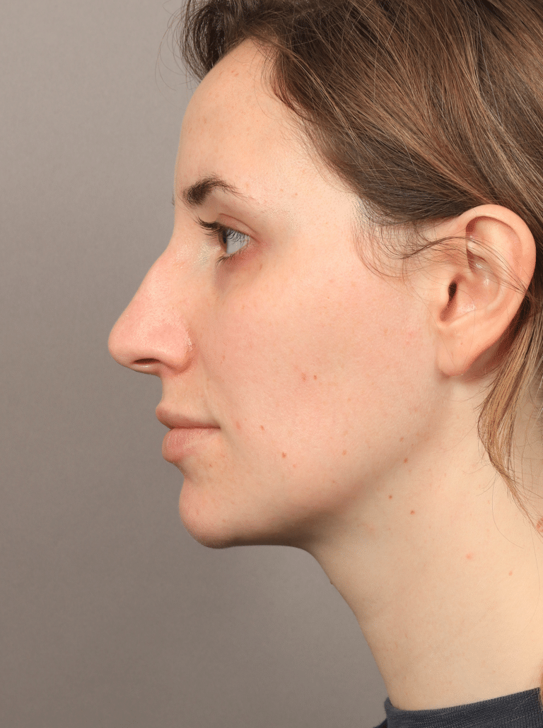 Before Image: Rhinoplasty (5.5 Months Post-op) - left-side
