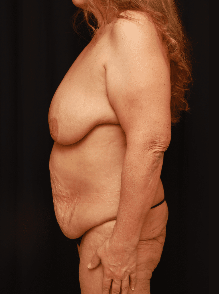 Before Image: Mommy Makeover (Tummy Tuck and Breast Lift with Implants) -