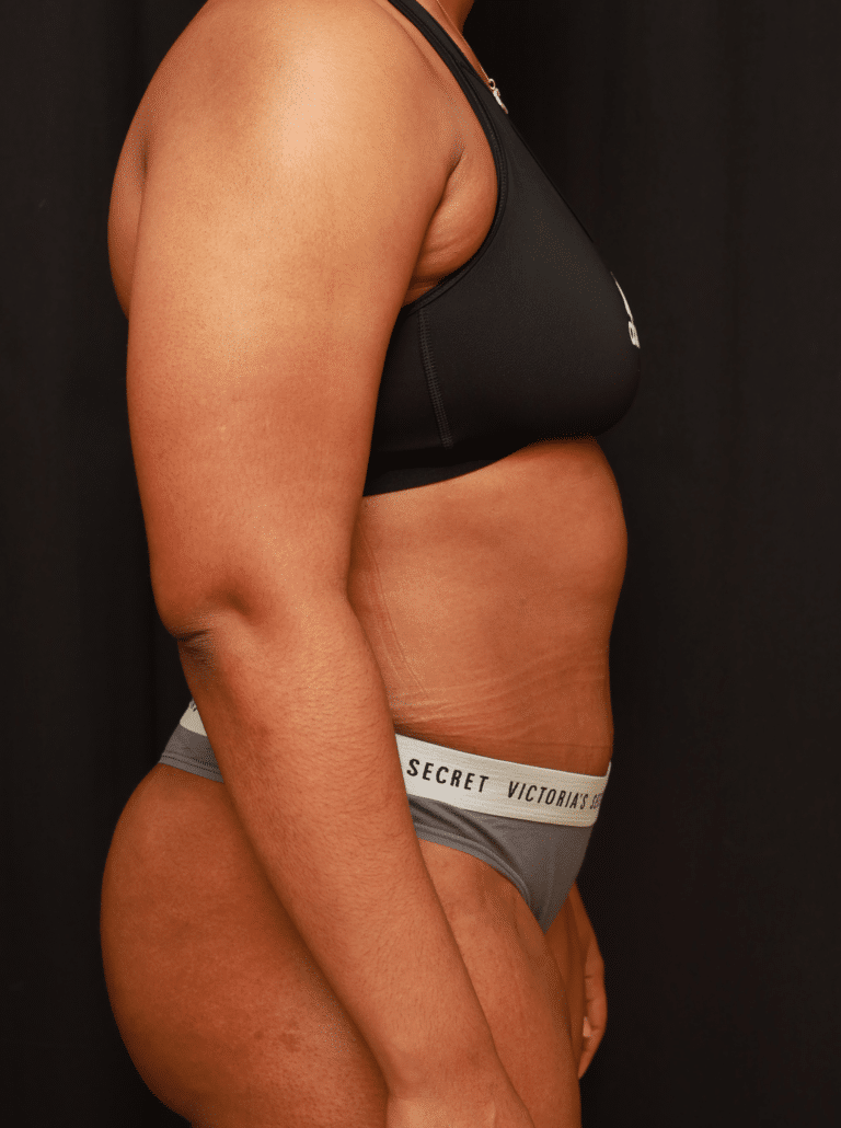 After Image: Tummy Tuck (5 Weeks Post-op) - right-side
