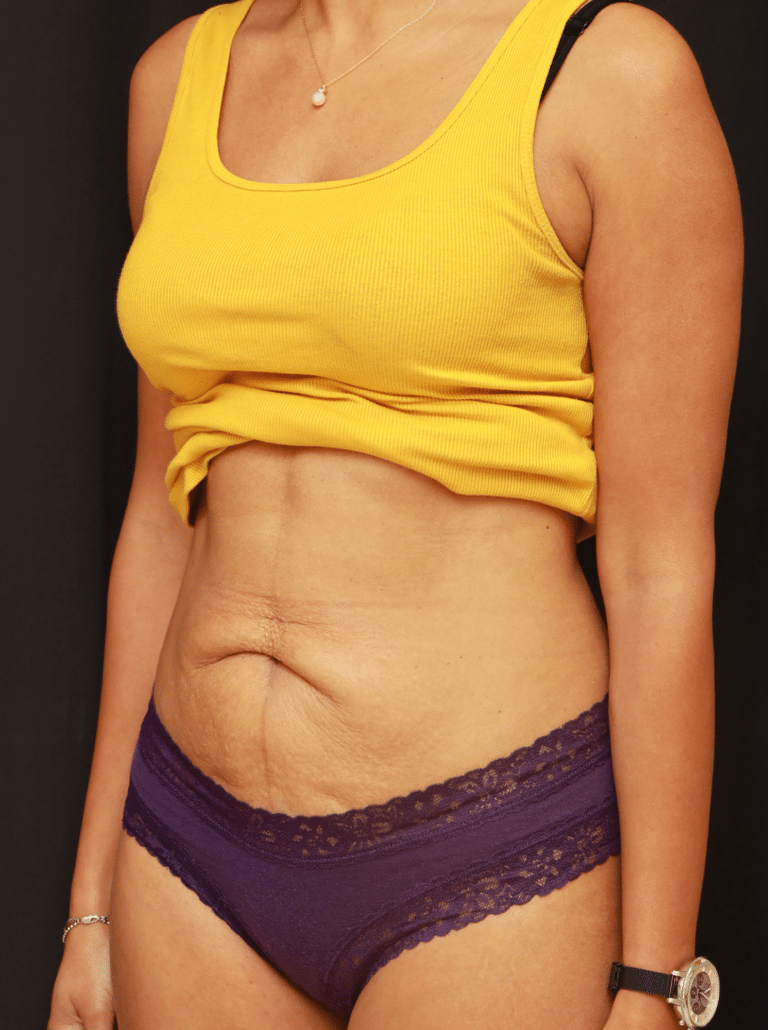 Before Image: Tummy Tuck (3 Months Post-op) - left-front-oblique