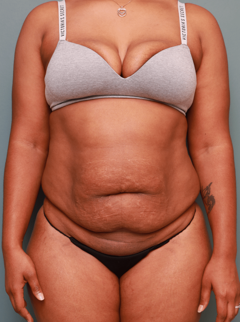 Before Image: Tummy Tuck (5 Weeks Post-op) - front