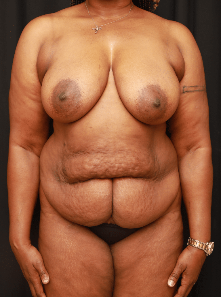 Before Image: Mommy Makeover (Tummy Tuck and Breast Lift) - front