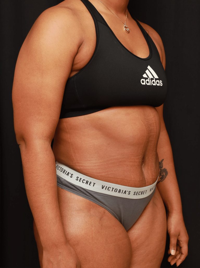 After Image: Tummy Tuck (5 Weeks Post-op) - right-front-oblique