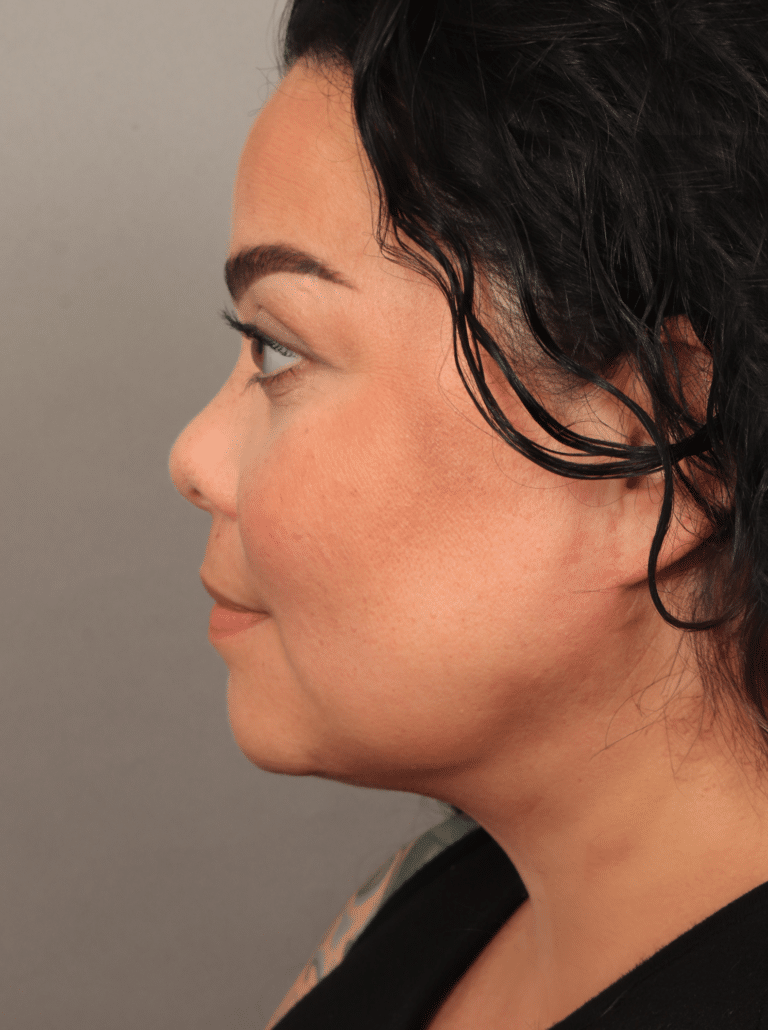 After Image: Upper Eyelid Lift, Buccal Fat Removal, and Vaser Lipo and Renuvion of the lower face and neck. - left-side