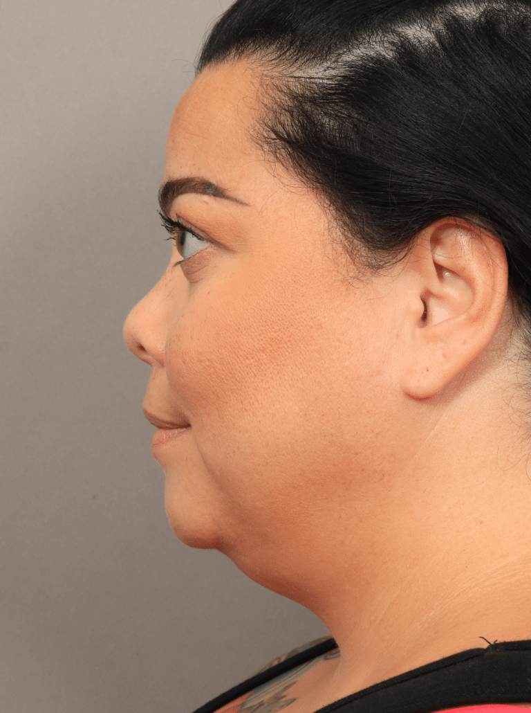 Before Image: Upper Eyelid Lift, Buccal Fat Removal, and Vaser Lipo and Renuvion of the lower face and neck. - left-side