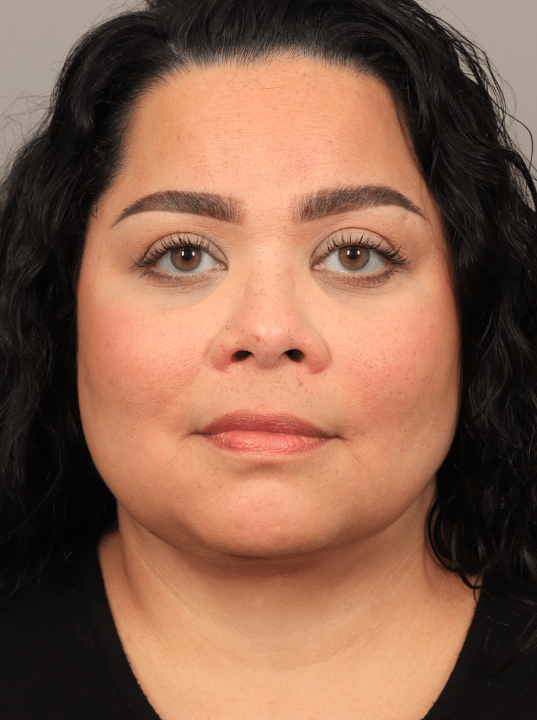 After Image: Upper Eyelid Lift, Buccal Fat Removal, and Vaser Lipo and Renuvion of the lower face and neck. - front