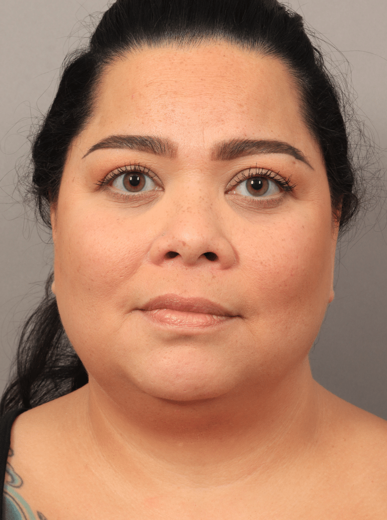 Before Image: Upper Eyelid Lift, Buccal Fat Removal, and Vaser Lipo and Renuvion of the lower face and neck. - front