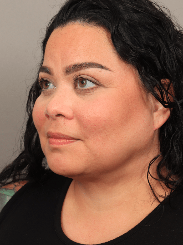 After Image: Upper Eyelid Lift, Buccal Fat Removal, and Vaser Lipo and Renuvion of the lower face and neck. - left-front-oblique