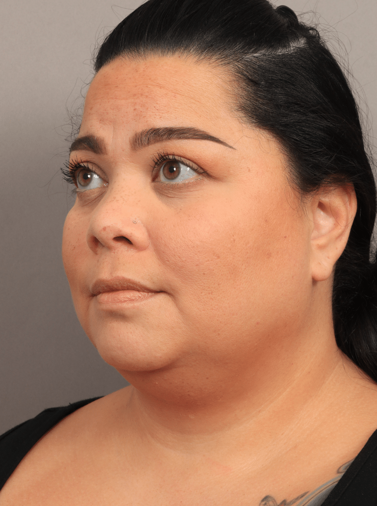 Before Image: Upper Eyelid Lift, Buccal Fat Removal, and Vaser Lipo and Renuvion of the lower face and neck. - left-front-oblique