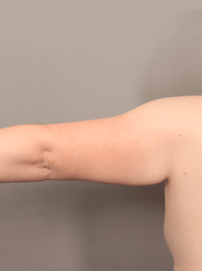 Before Image: Liposuction and Renuvion Skin Tightening (1 Month Post-op) - front