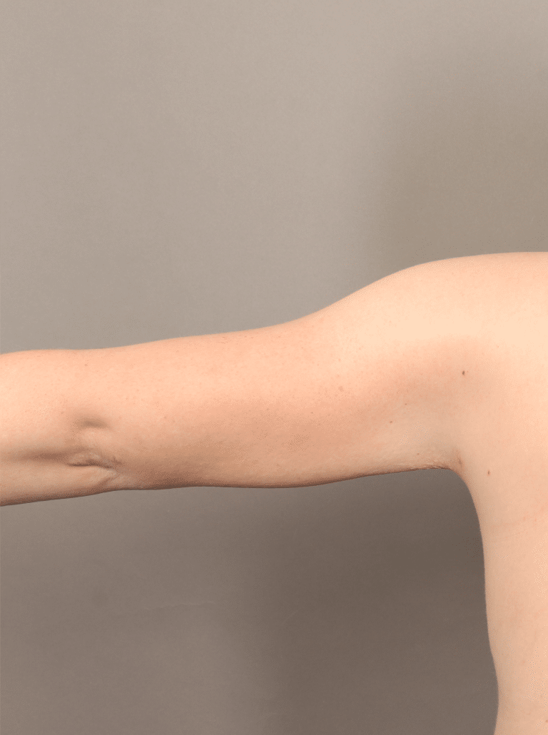 After Image: Liposuction and Renuvion Skin Tightening (1 Month Post-op) - front