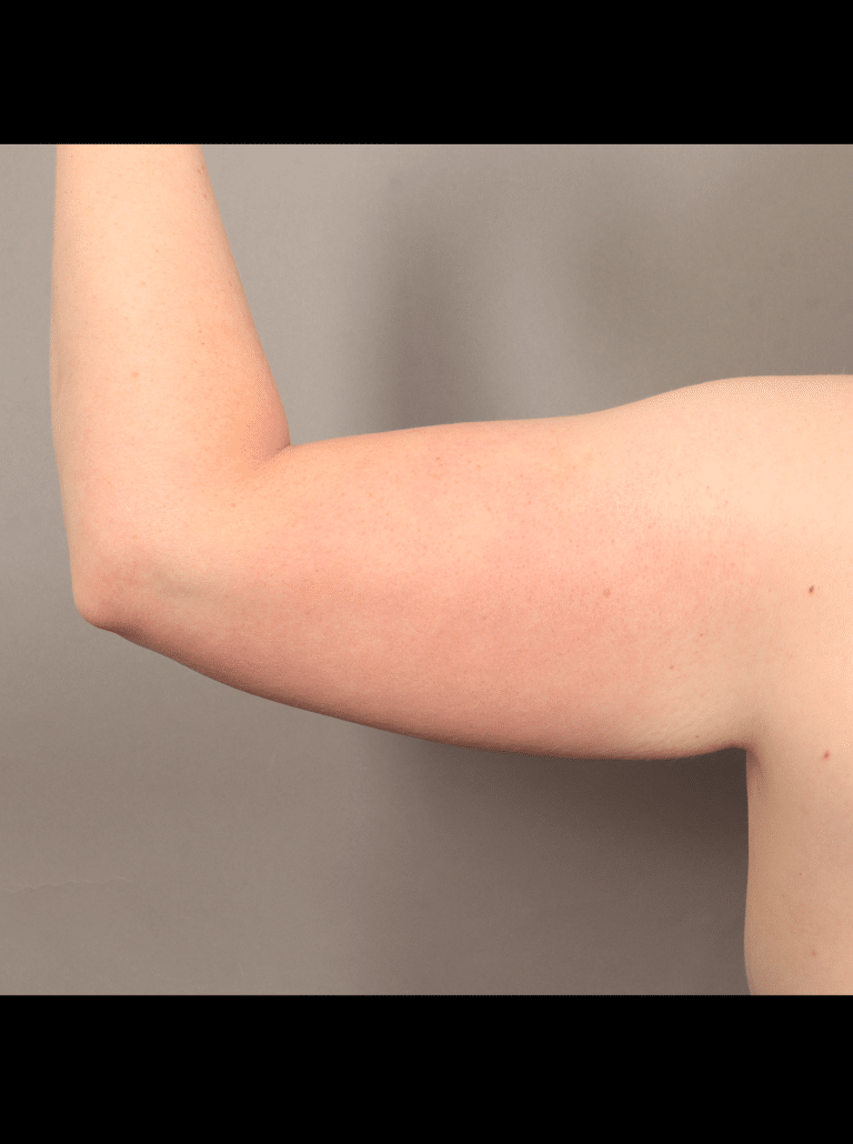 Before Image: Liposuction and Renuvion Skin Tightening (1 Month Post-op) -