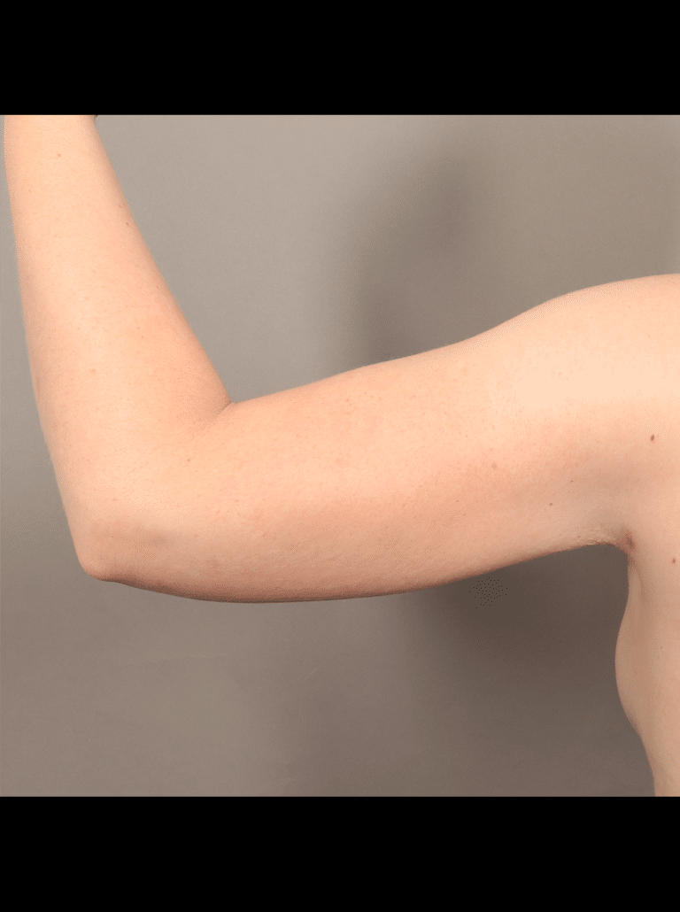 After Image: Liposuction and Renuvion Skin Tightening (1 Month Post-op) -