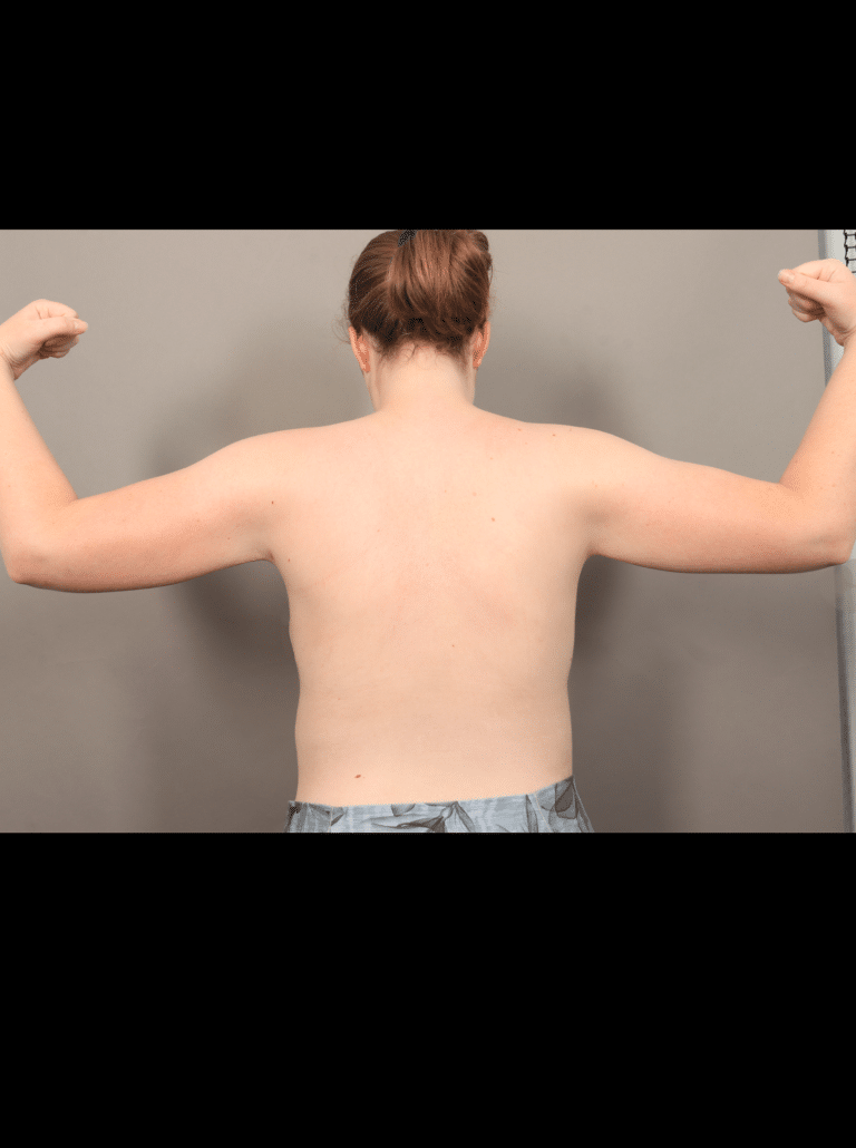 After Image: Liposuction and Renuvion Skin Tightening (1 Month Post-op) - back