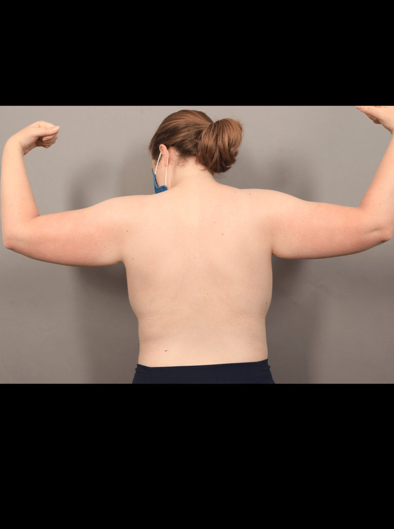 Before Image: Liposuction and Renuvion Skin Tightening (1 Month Post-op) - back