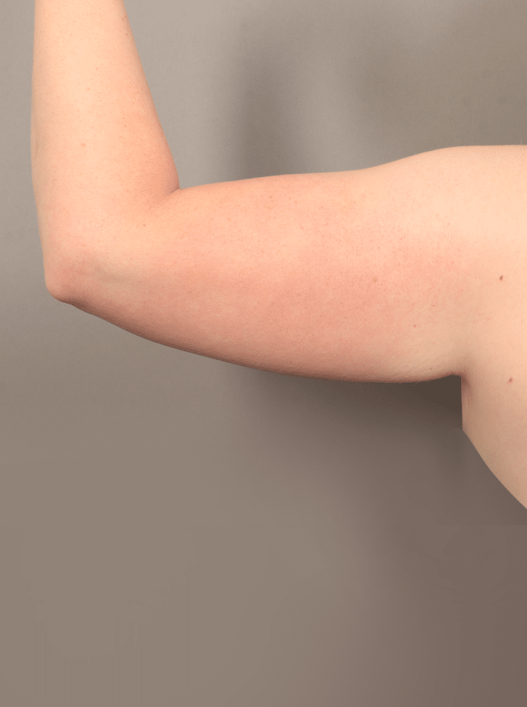 Before Image: Liposuction and Renuvion Skin Tightening (1 Month Post-op) - front
