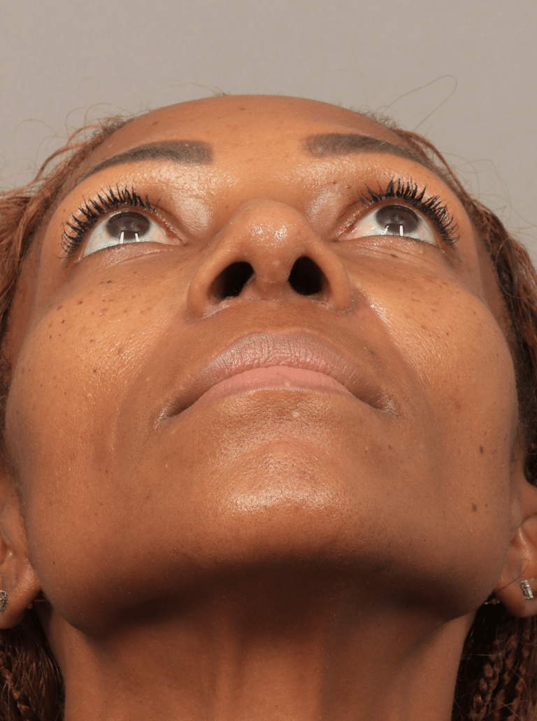 After Image: Rhinoplasty (15 Days Post-op) - front