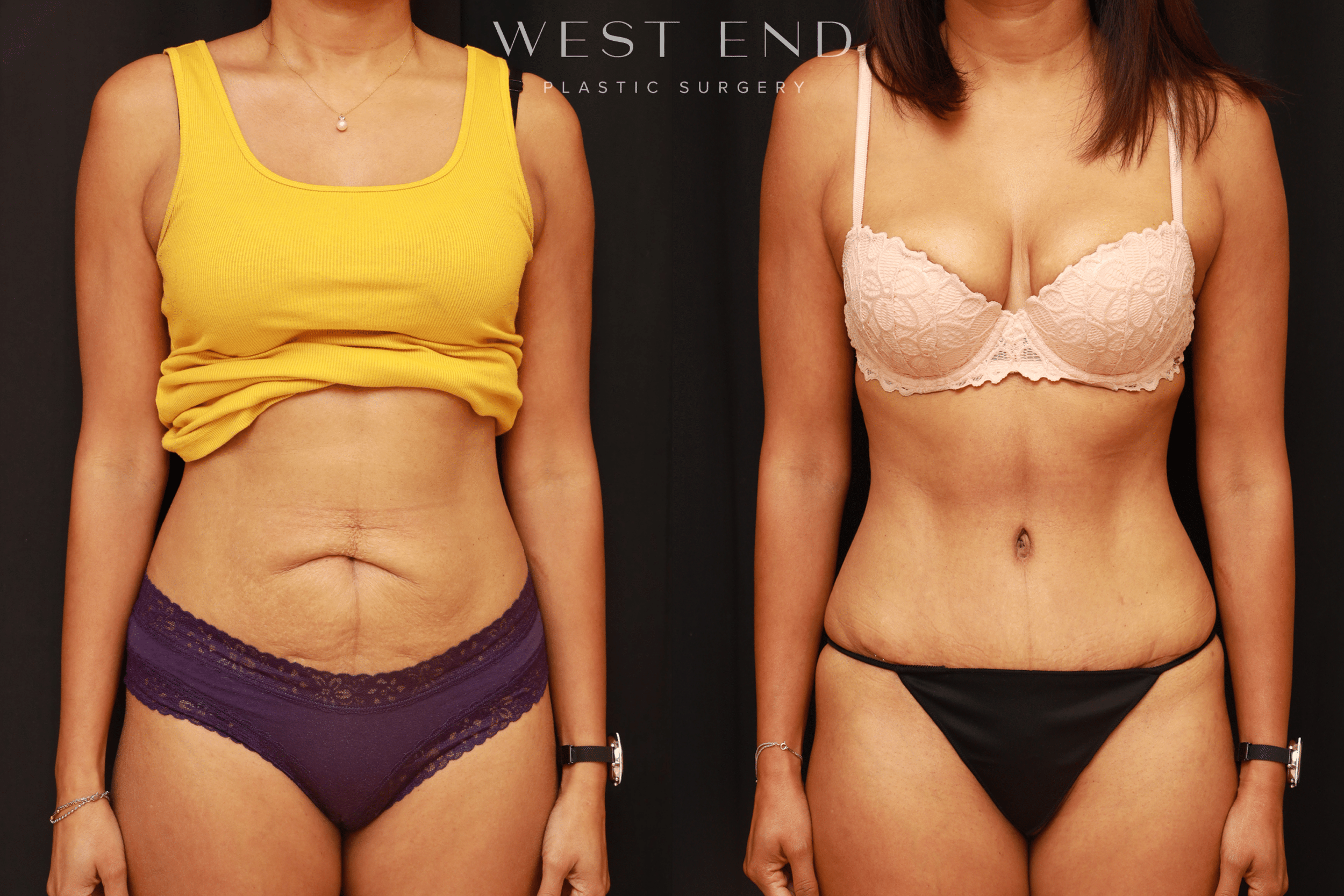 Tummy Tuck Results Washington DC