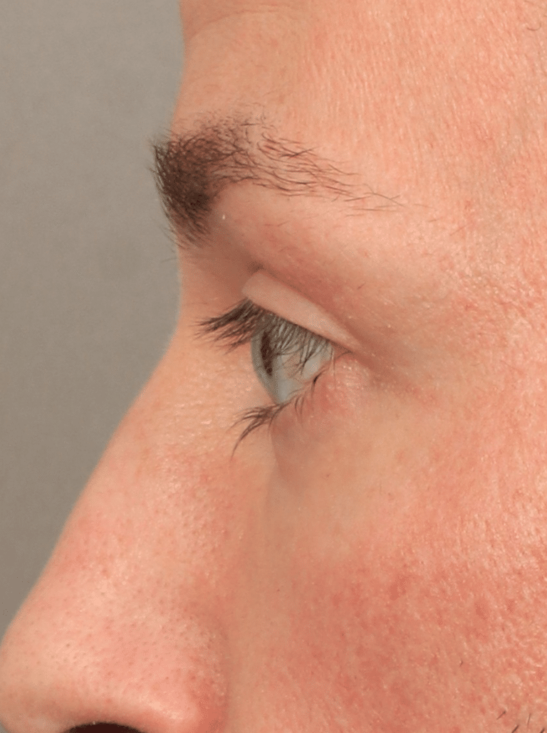 After Image: Upper & Lower Eyelid Lift (4.5 Months Post-op) - left-side
