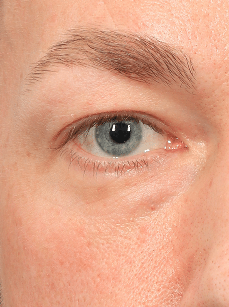 Before Image: Upper & Lower Eyelid Lift (4.5 Months Post-op) - front