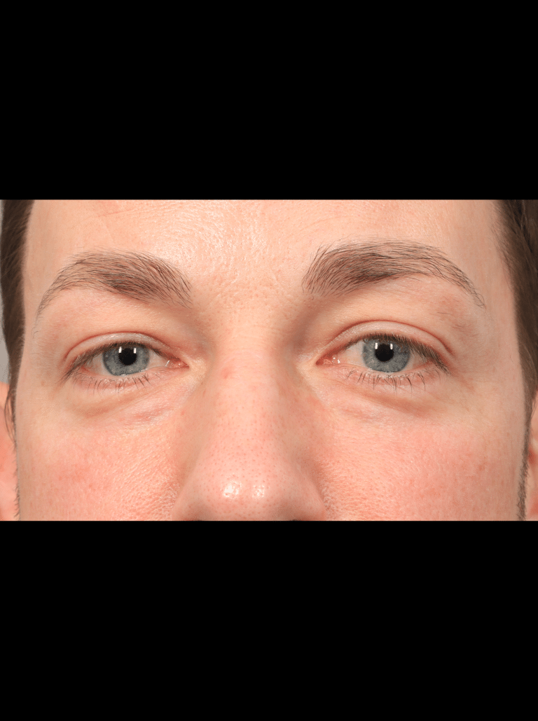 Before Image: Upper & Lower Eyelid Lift (4.5 Months Post-op) - front