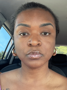 Before Image: Cheek & Chin Filler
