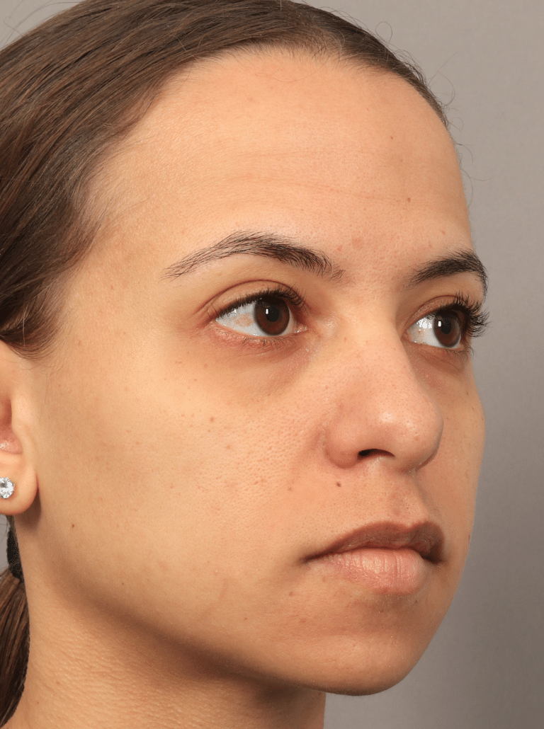 Before Image: Lower Blepharoplasty (3.5 Months Post-op) - right-front-oblique