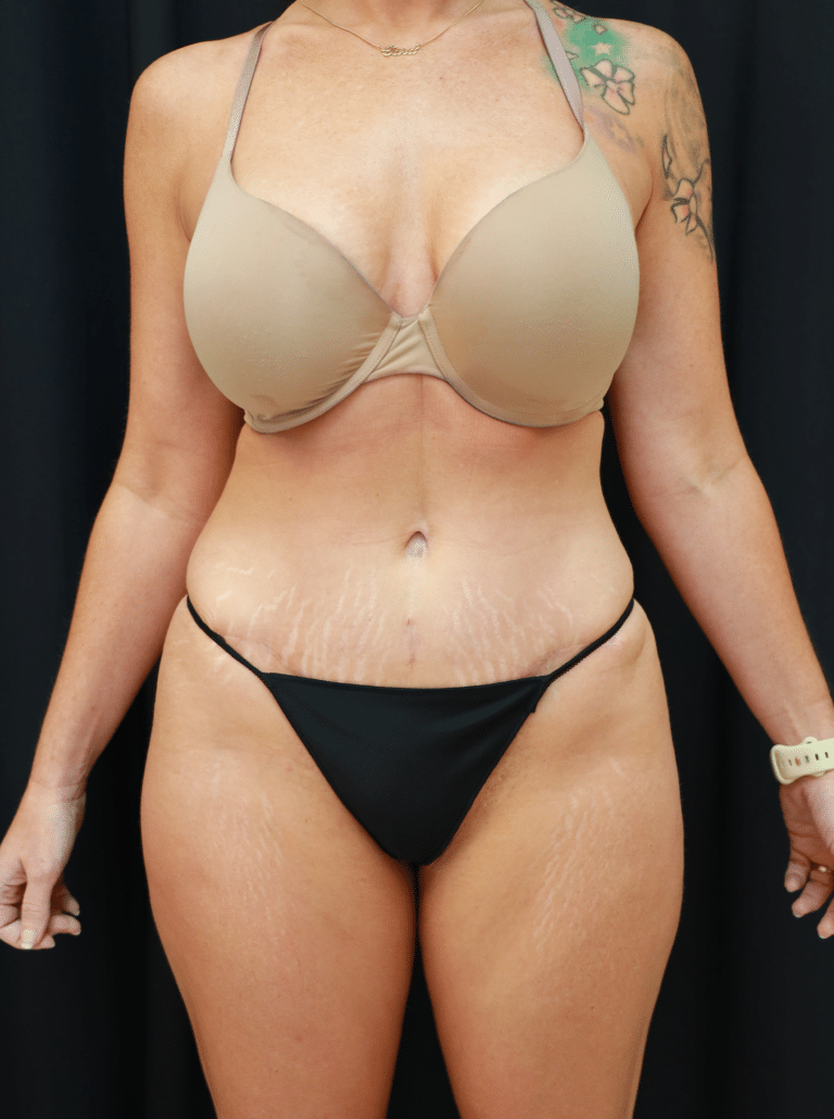 After Image: Tummy Tuck, Liposuction, and Fat Grafting to Hips (6 Months Post-op) - front