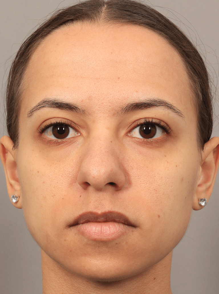 Before Image: Lower Blepharoplasty (3.5 Months Post-op) - front