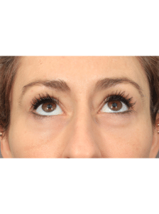 After Image: Upper/Lower Blepharoplasty (Eyelid Lift), Brow Lift, Deep Plane Facelift and Neck Lift, Buccal Fat Removal, Fat Grafting, and CO2 Laser Resurfacing (1 Year Post-op)