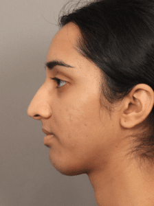 Before Image: Rhinoplasty with an Alarplasty (4 Months Post-op)